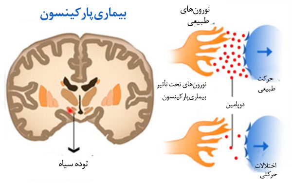 پارکینسون