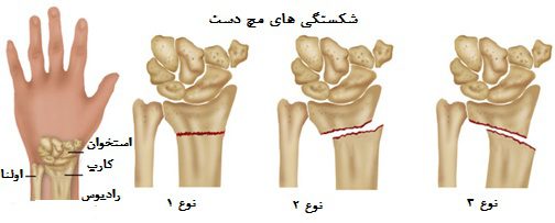فیزیوتراپی مچ دست در منزل فیزیوتراپی مچ دست در منزل