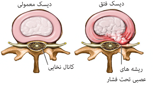 فیزیوتراپی فتق دیسک کمر