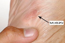 علائم پای دیابتی