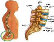 بهترین درمان دیسک کمر
