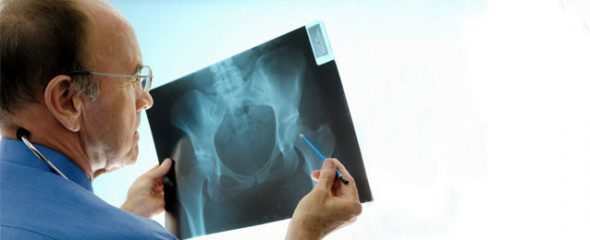 فیزیوتراپی شکستگی لگن