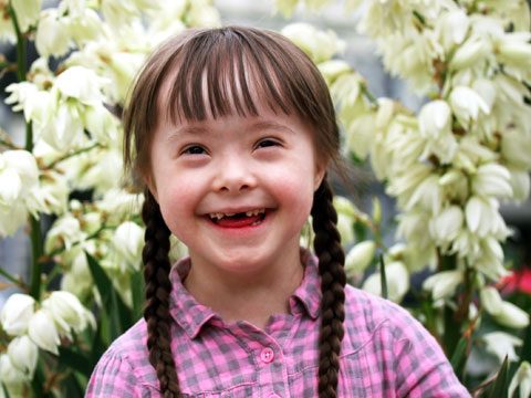 توانبخشی سندرم داون