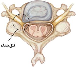فتق دیسک گردنی
