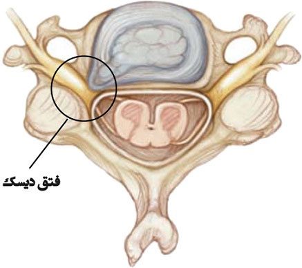 فتق دیسک گردنی