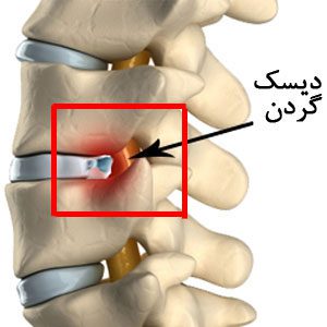 فتق دیسک گردنی
