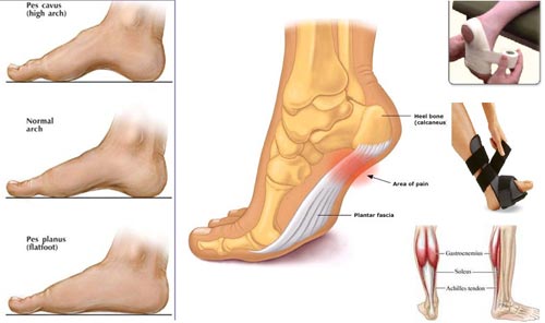 درمان خار پاشنه پا درمان خار پاشنه پا