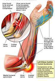 سندروم تونل اولنار