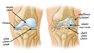 ساییدگی زانو