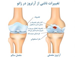 روش درمان ساییدگی زانو
