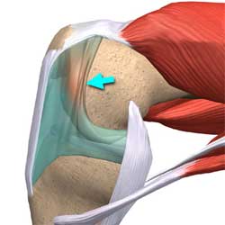 سندروم پلیکا سندروم پلیکا