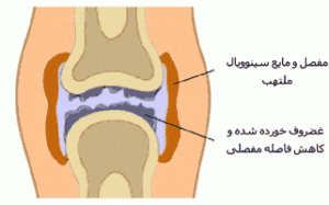 روماتیسم مفصلی