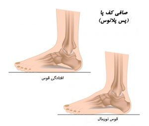 تشخیص صافی کف پا