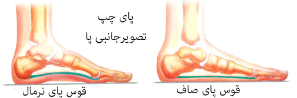 تشخیص صافی کف پا