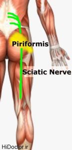 سندروم پیریفورمیس