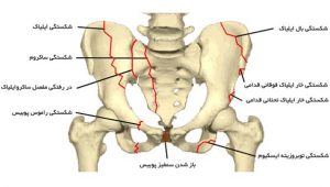 شکستگی لگن ، فیزیوتراپی شکستگی لگن
