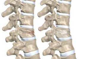 شکستگی مهره های گردن