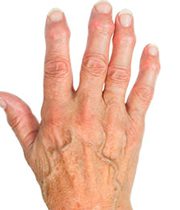 آرتروز انگشتان دست