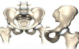 فیزیوتراپی مفصل لگن - فیزیوتراپی بعد از تعویض مفصل لگن