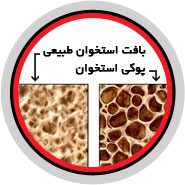 پوکی استخوان