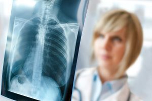 پوکی استخوان در زنان