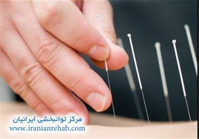 طب سوزنی در تهران