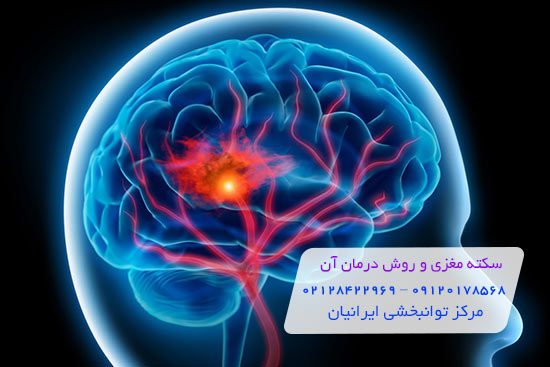 سکته مغزی و درمان سکته مغزی