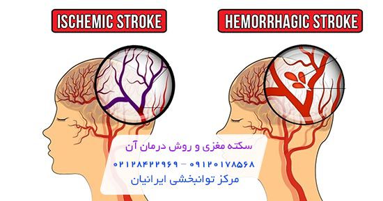 پیامدها و عوارض سکته مغزی
