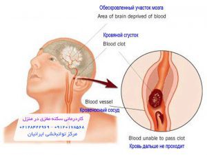 کادرمانی سکته مغزی