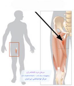 درمان درد کشاله ران