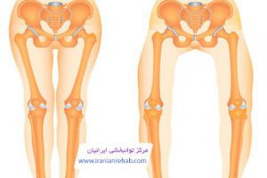 پای پرانتزی چیست