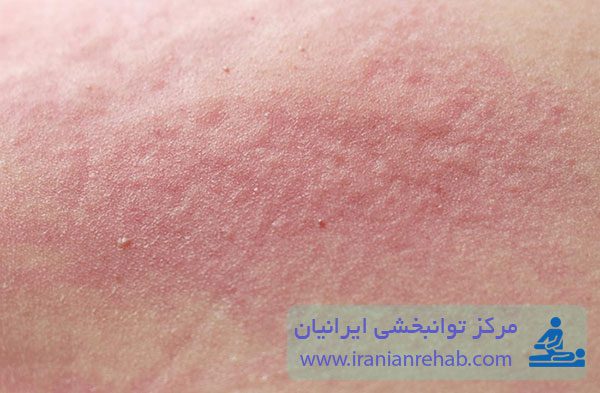 بثورات پوستی