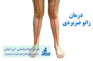 درمان زانو ضربدری