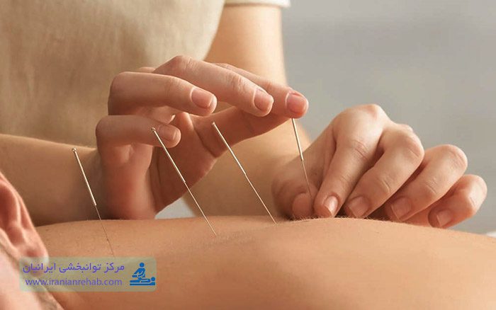 تاثیر طب سوزنی در فلج مغزی