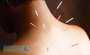 درمان فلج مغزی با طب سوزنی