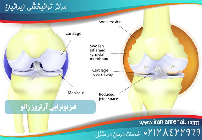 فیزیوتراپی آرتروز زانو
