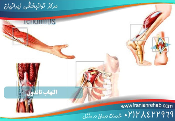 انواع التهاب تاندون