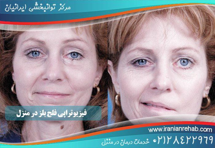 فیزیوتراپی فلج بلز در منزل