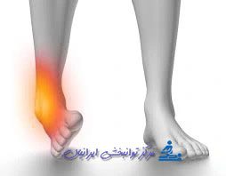 انواع پیچ خوردگی مچ پا