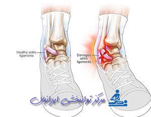 فیزیوتراپی مپ پا در منزل