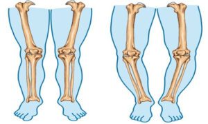 درمان زانو پرانتزی با فیزیوتراپی