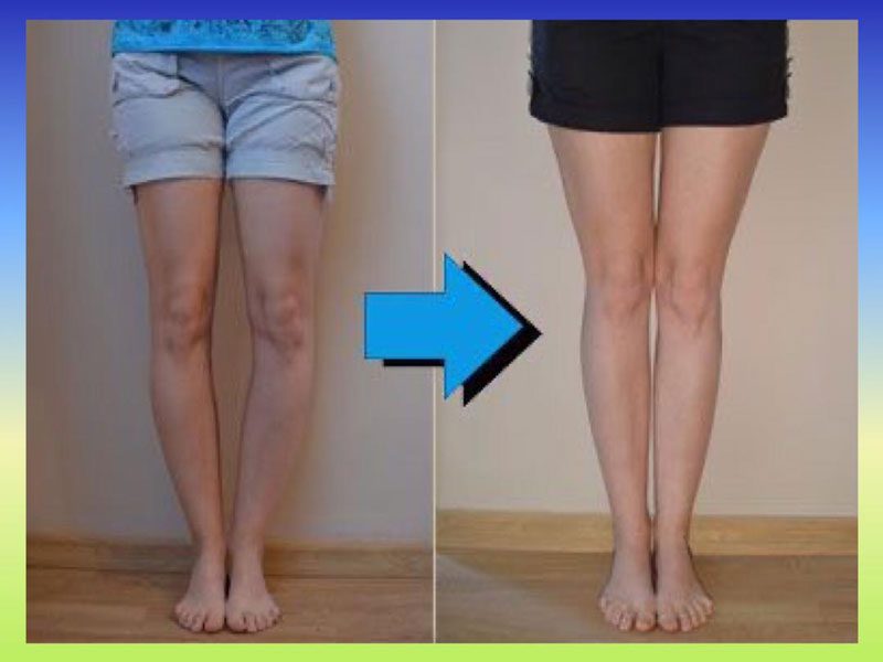 مدت زمان درمان زانو پرانتری