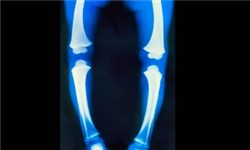 مدت زمان درمان زانو پرانتری