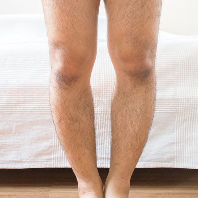 علت پرانتزی شدن پا در بزرگسالی