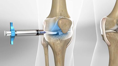 امپول هیالورونیک اسید برای درمان بیماری های زانو