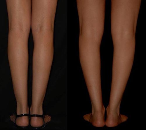 مدت زمان درمان زانو پرانتری