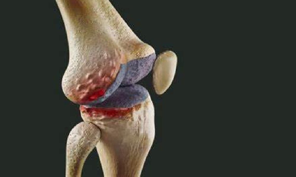 درمان آسیبهای مینیسک زانو