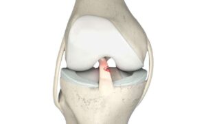 پارگی رباط زانو