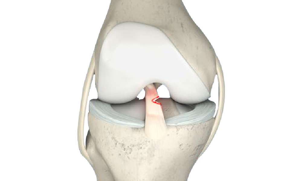 پارگی رباط زانو