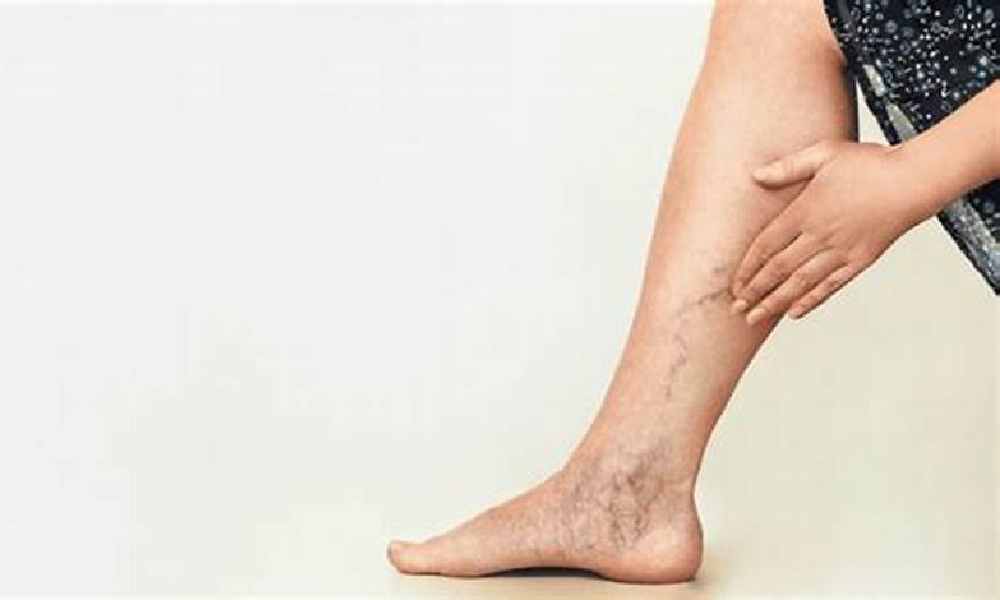 درمان واریس با فیزیوتراپی